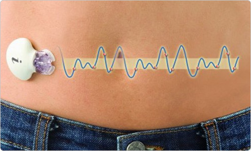 Новая система непрерывного мониторинга уровня сахара в подкожно жировой клечатке