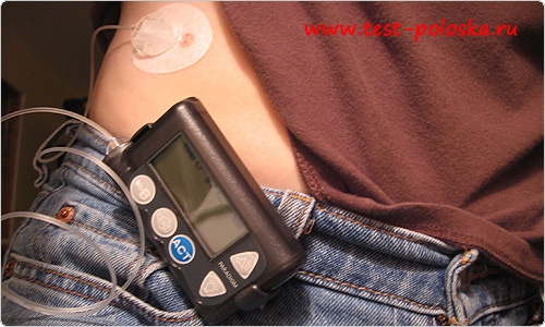Инсулиновая помпа медтроник на пробный период