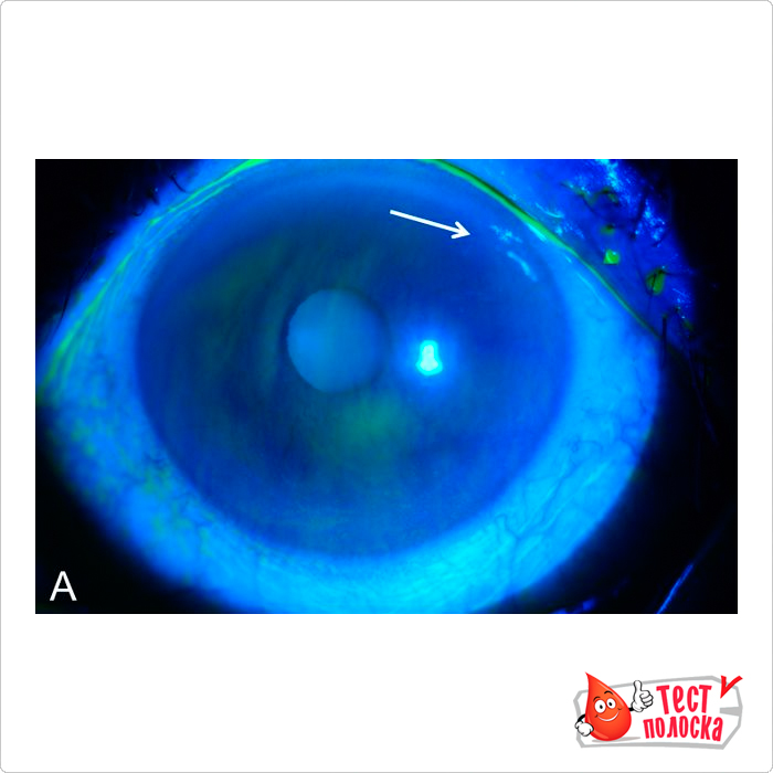 Окраска роговицы глаза человека флуоресцеином, сделанным под кобальтовым-синим фильтром