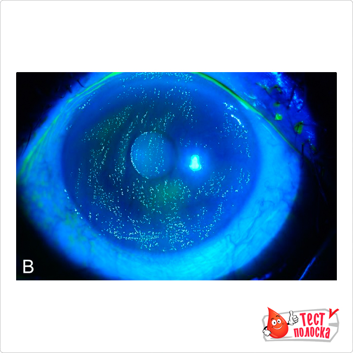 Окраска роговицы глаза человека флуоресцеином, сделанным под кобальтовым-синим фильтром