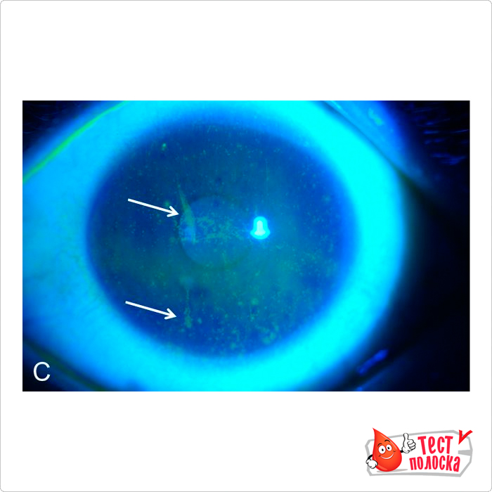 Окраска роговицы глаза человека флуоресцеином, сделанным под кобальтовым-синим фильтром